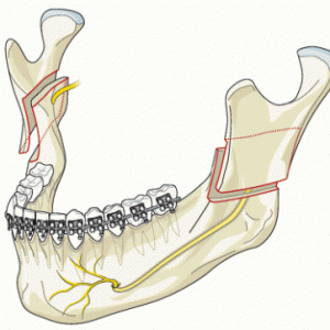 Ostéotomie Haute ou Courte, possibilité de corriger la position de l'angle mandibulaire
