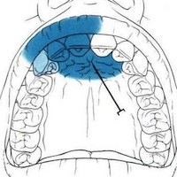 anesthésie locale à savoir