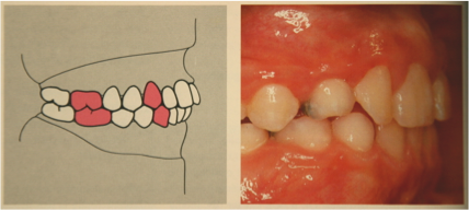 chirurgie orthognathique