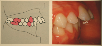 chirurgie orthognathique
