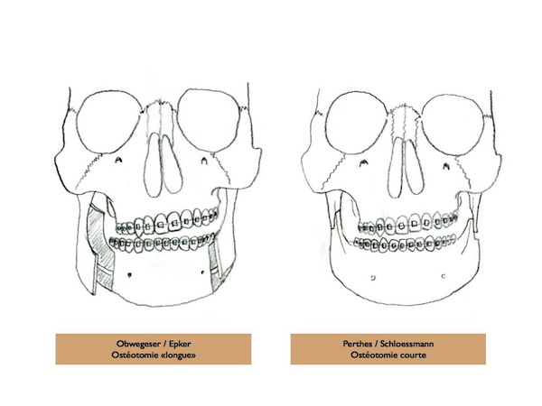 osteoPerthes-ScholsmannAngle