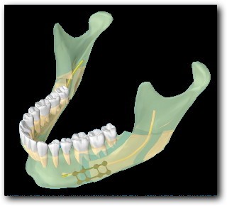 Ostéotomie-basse-de-type-Epker