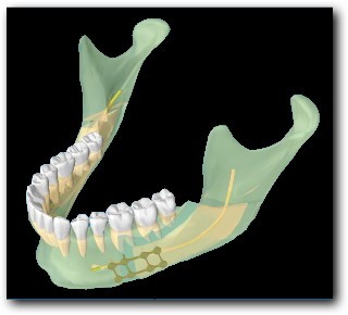 Ostéotomie-basse-de-type-Obwegeser