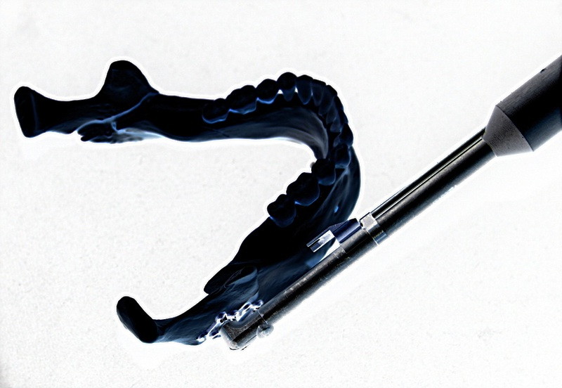 tournevis de Fritzemeier permettant de synthéser les fragments osseux par une mini-incision