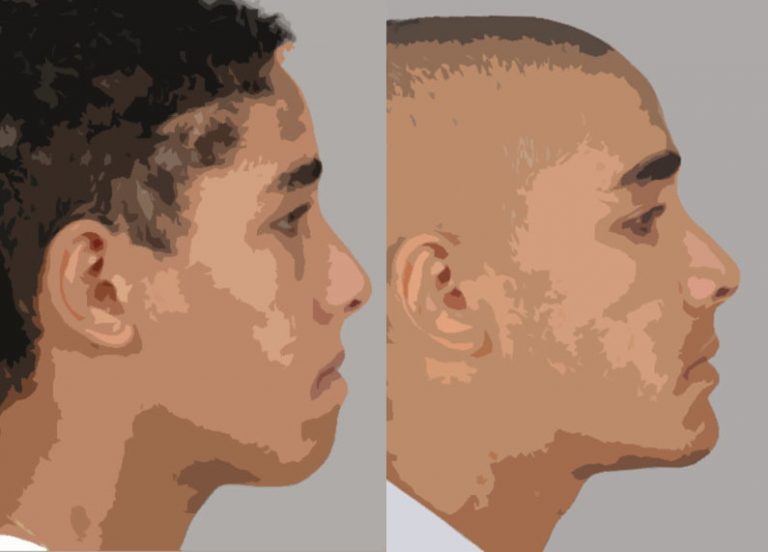 rétro-maxillie avec pro-mandibulie avec excès de hauteur symphysaire (à gauche), puis avancée maxillaire, recul mandibulaire et avancée et diminution de hauteur du menton (à droite).