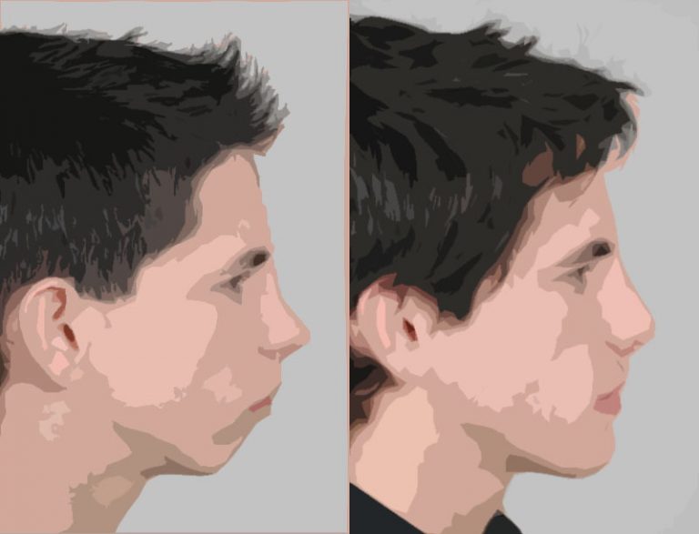 rétro-mandibulie avec rétro-génie (à gauche) puis avancée mandibulaire avec génioplastie d’avancée et de diminution de hauteur (à droite).
