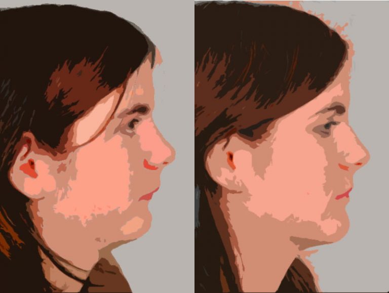 rétro-mandibulie sans rétrogénie (à gauche) puis avancée mandibulaire (à droite).
