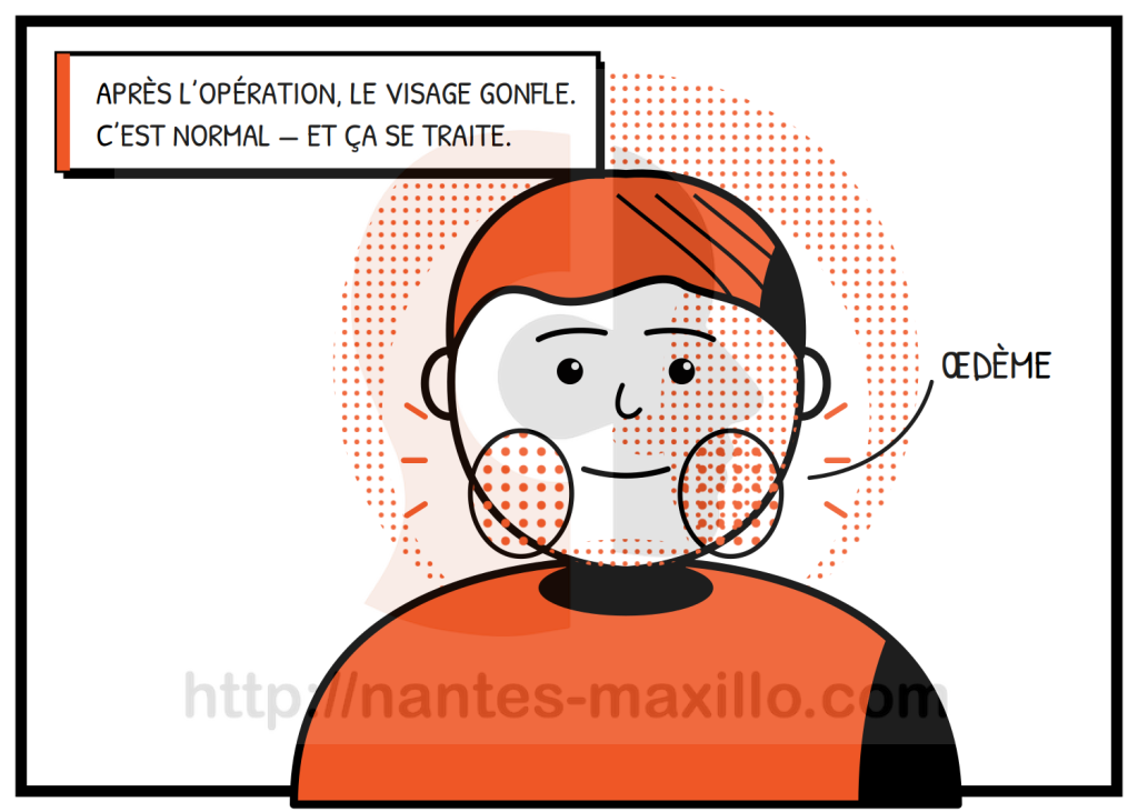 Zones de gonflement du visage après une chirurgie orthognathique